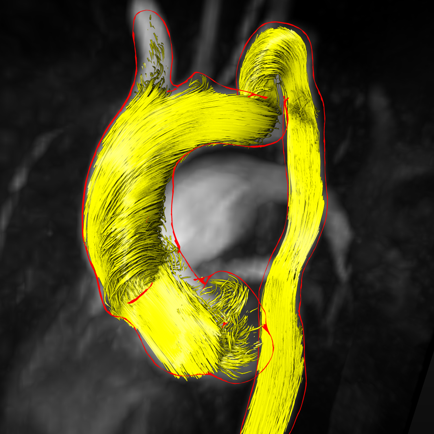 Visualization of Cardiac Blood Flow Using Anisotropic Ambient Occlusion for Lines