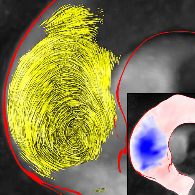 Pressure-based vortex extraction in cardiac 4D PC-MRI blood flow data