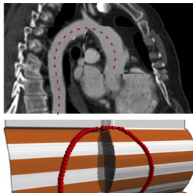 Bilateral Depth Filtering for Enhanced Vessel Reformation