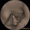Virtuelle Endoskopie mit Force -- Feedback-Unterstützung für die Operationsplanung an Nasennebenhöhlen