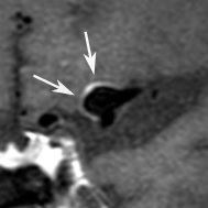 Multimodal validation of focal enhancement in intracranial aneurysms as a surrogate marker for aneurysm instability