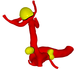 A Geometric Optimization Approach for the Detection and Segmentation of Multiple Aneurysms