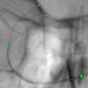 Virtual enhancement of marker X-ray visibility for cerebral stents and flow diverters