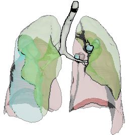 Illustrative PET/CT Visualisation of SIRT-treated Lung Metasteses