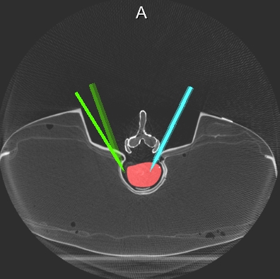 A Software Prototype for Treatment Planning and Intervention Support of Robot-Assisted Radiofrequency Ablations of Vertebral Metastases