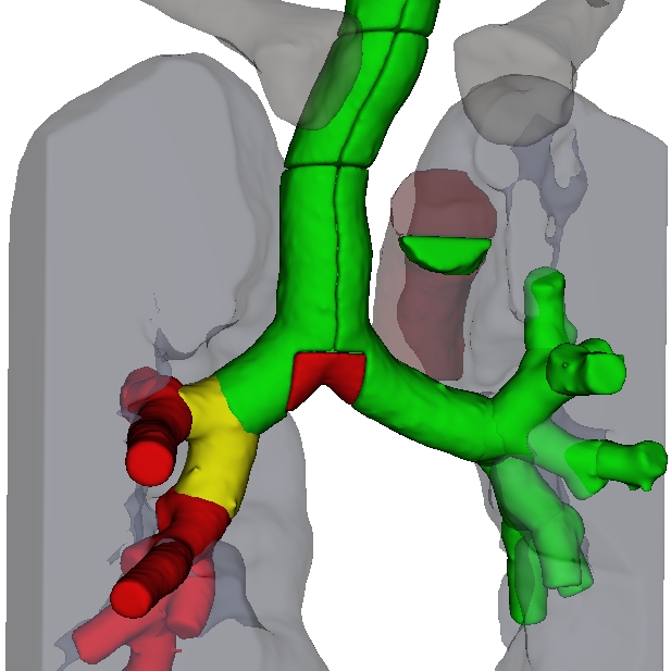 Towards Automated Reporting and Visualization of Lymph Node Metastases of Lung Cancer