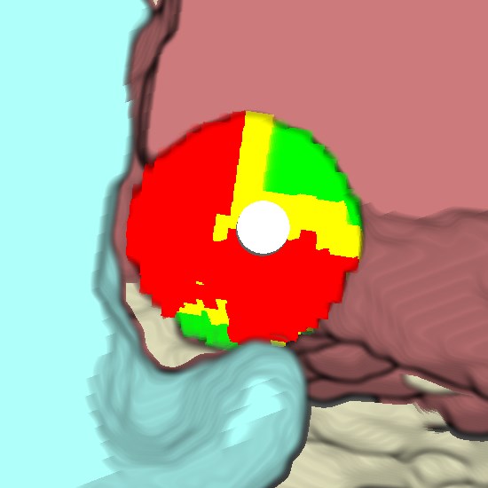 A Two-Step Risk Assessment Method for Radiofrequency Ablations of Spine Metastases