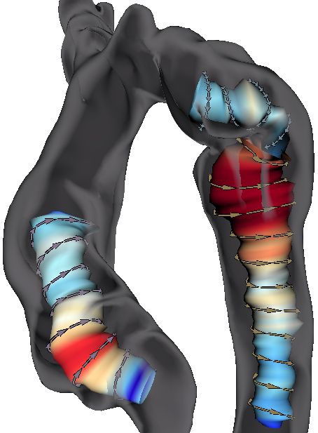 Semi-automatic Vortex Flow Classification in 4D PC-MRI Data of the Aorta