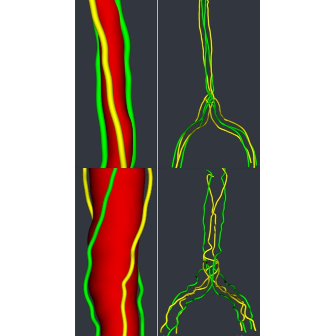 Visual Assessment of Vascular Torsion using Ellipse Fitting