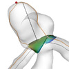 Geometric Reconstruction of the Ostium of Cerebral Aneurysms