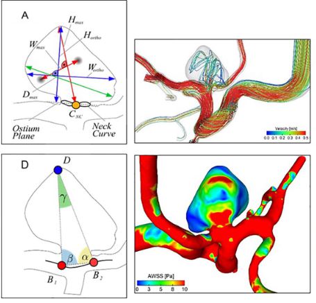 Rupture risk assessment for multiple intracranial aneurysms: why there is no need for dozens of clinical, morphological and hemodynamic parameters