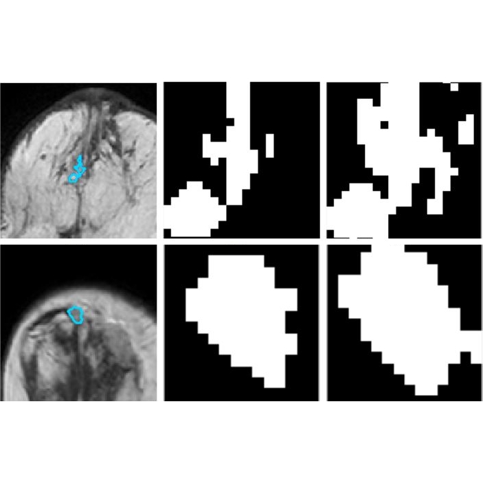 Classification of DCE-MRI Data for Breast Cancer Diagnosis Combining Contrast Agent Dynamics and Texture Features