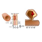 Interactive exploration of a 3D intracranial aneurysm wall model extracted from histologic slices