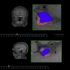 Wall enhancement segmentation for intracranial aneuryms