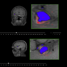 Wall enhancement segmentation for intracranial aneuryms