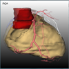 Integrierte Visualisierung von Anatomie und Perfusion des Myokards zur Früherkennung der Koronaren Herzkrankheit