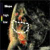 Interactive Visual Analysis of Perfusion Data