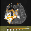 Intuitive Mapping of Perfusion Parameters to Glyph Shape