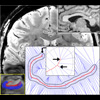 Measurement of the Stratum Radiatum/Lacunosum-Moleculare (SRLM)