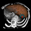 3D-Interaction Techniques for Planning Oncologic Soft Tissue Operations