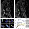 Computer-Aided Diagnosis in Breast DCE-MRI - Quantification of the Heterogeneity of Breast Lesions