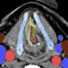 The Tumor Therapy Manager - Design, Refinement and Clinical Use of a Software Product for ENT Surgery Planning and Documentation