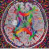 Survey of glyph-based visualization techniques for spatial multivariate medical data