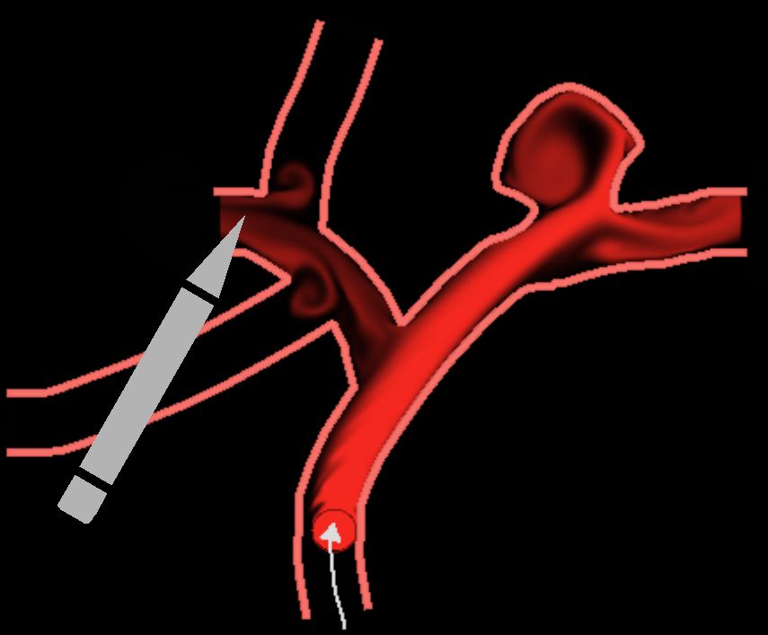 Sketching 2D Vessels and Vascular Diseases with Integrated Blood Flow