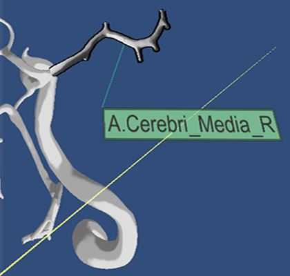 3D User Interfaces for Interactive Annotation of Vascular Structures