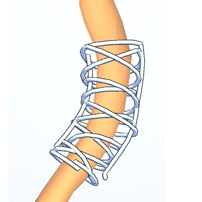 3D Sketching on Interactively Unfolded Vascular Structures for Treatment Planning