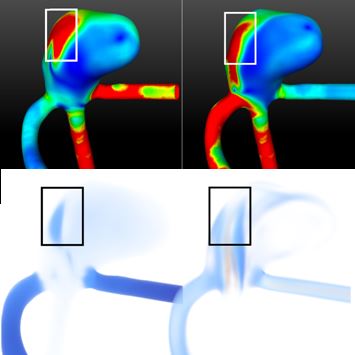 Uncertainty Visualization of Ensemble Hemodynamic Simulations for a Cerebral Bifurcation Aneurysm