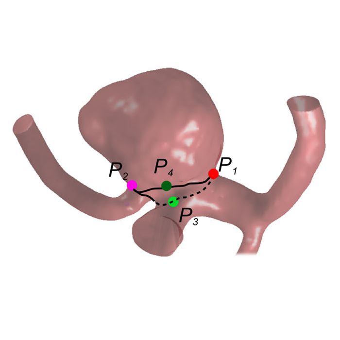 Semiautomatic neck curve reconstruction for intracranial aneurysm rupture risk assessment based on morphological parameters