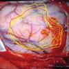 Prototype of an AR-Based System for Enhanced Visualization Functionality in Navigated Neurosurgery