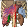 Combining Silhouettes, Surface, and Volume Rendering for Surgery Education and Planning