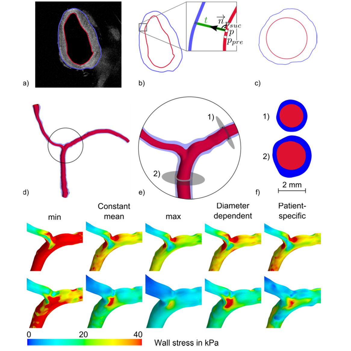 Fluid-structure interaction in intracranial vessel walls: The role of patient-specific wall thickness